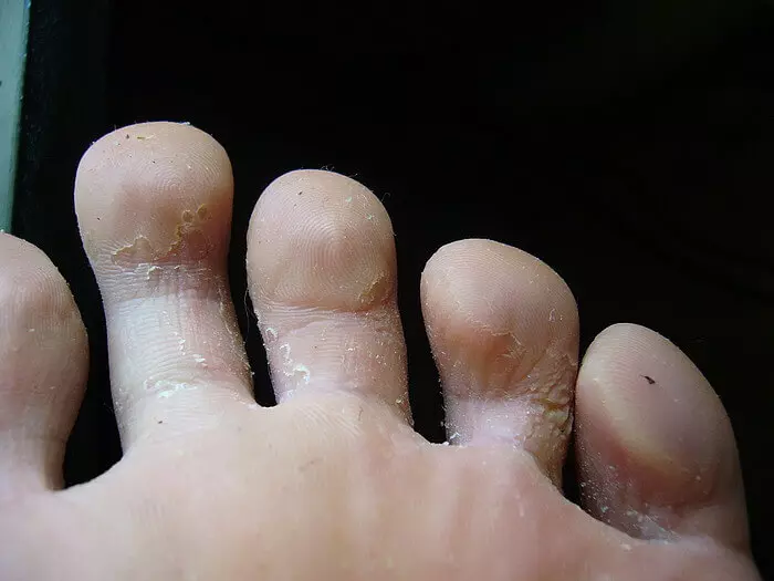Грибок между пальцами: проверяем симптомы, выбираем лечение