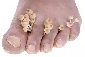 Білі плями на нігтях пальців рук або ніг, і як їх лікувати » журнал здоров'я iHealth 2