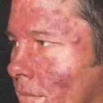 Розацеа на обличчі й тілі: фото, симптоми, причини і лікування » журнал здоров'я iHealth 7