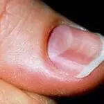 Почему ногтевая пластина неровная