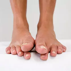 toe-fungus