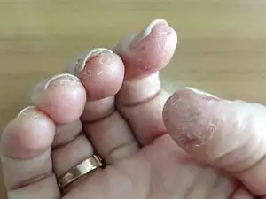 аллергия на пальцах