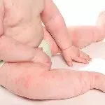 крапивница на теле малыша