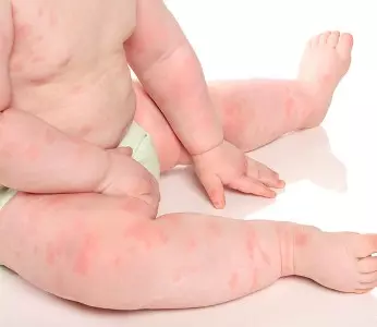 типичные симптомы острой крапивницы