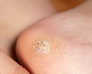 бородавки на стопе
