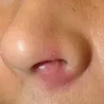 Фурункул в носу как лечить