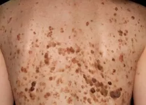 серобейный кератоз на спине