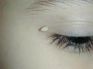 нитьевидная бородавка возле глаза