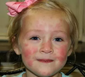 хроническая аутоиммунная патология на лице 