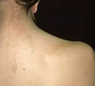 невус папилломотозный