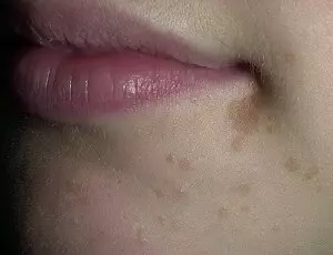 плоские бородавки на лице