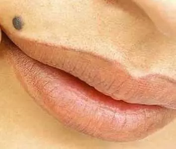 невус над губой