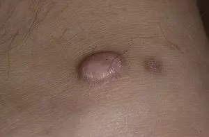 Дерматофиброма