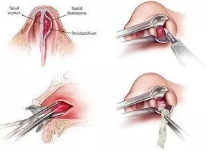 схема удаление фурункула в носу
