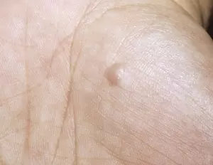 Дерматофиброма новообразование