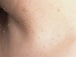 папиломы на коже