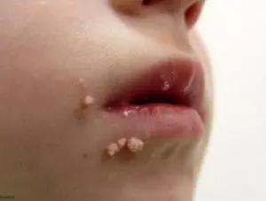 паиломы на лице ребенка