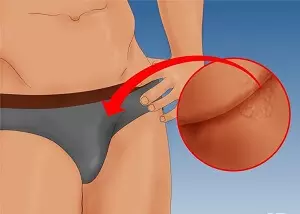 Рисунок остроконечные кандиломы у мужчин