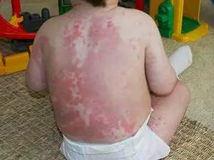 Многоформная экссудативная эритема у детей