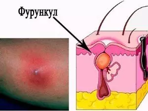 строение фурункула схема