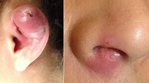 фурункул в ухе и в носу