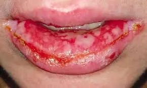 Многоформная экссудативная эритема в полости рта