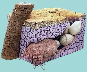 чесоточный клещ