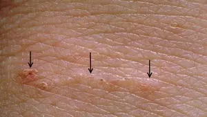 тонель чесоточного клеща