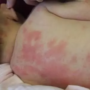 эритема у новорожденного на спине