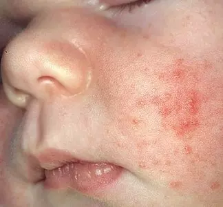 эритема у новорожденных на щеках