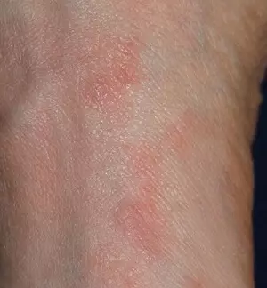 красные пятна после чесотки
