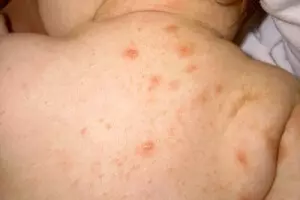 коричневые пятна после чесотки