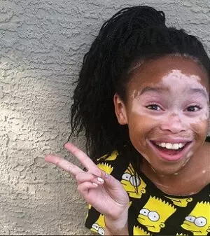 витилиго у африканской девочки