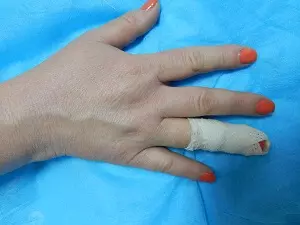 травма пальца на руке