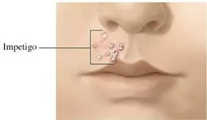 рисунок стрептококкового импетиго на лице