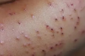 узелки почесухи