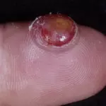 Пиогенная гранулема на пальце