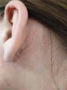 шелушение кожи за ухом
