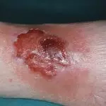 запущенная пиодермия на ноге