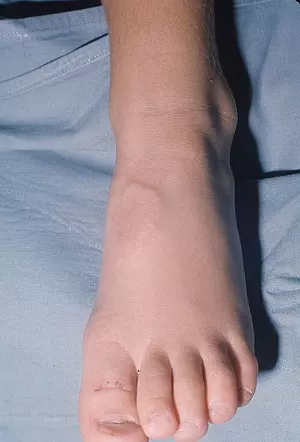 подкожная гранулема на ноге ребенка