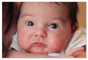 лицо младенца с сыпью