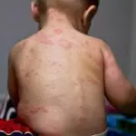 розеола у малыша на спине