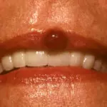 Пиогенная гранулема в области верхней губы
