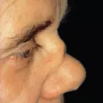 Седловидная форма носа при нарушении целостности носовой перегородки