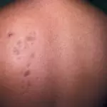 Узловатая склеродермия на спине