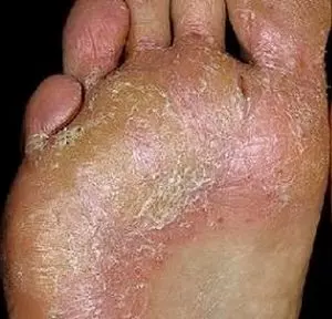 грибок на стопе