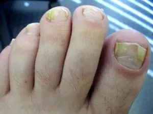 грибок ногтей