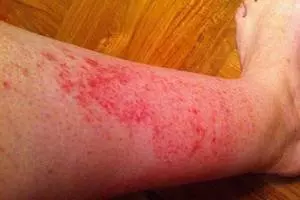 аллергические пятна на ноге