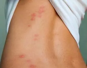красные пятна на спине