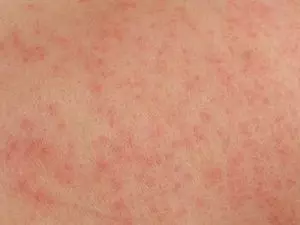 сыпь при стрессе